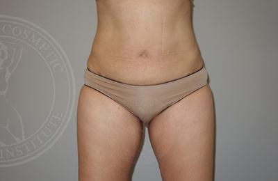 sixsurgery toronto liposuction before and after