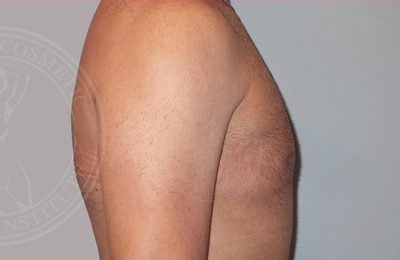 sixsurgery toronto male liposuction before and after