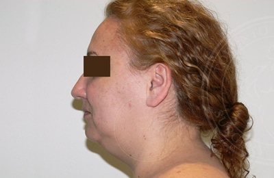 sixsurgery toronto face liposuction before and after
