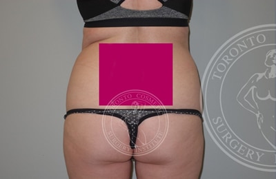 sixsurgery toronto flanks liposuction before and after