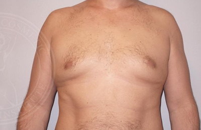 Male Breast Reduction Gallery