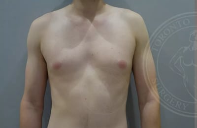 Male Breast Reduction Gallery
