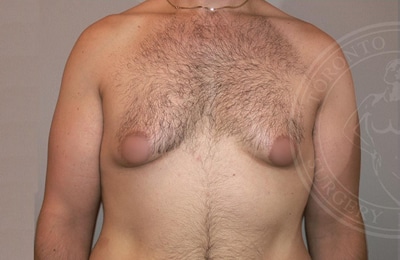 sixsurgery toronto male breast reduction before and after