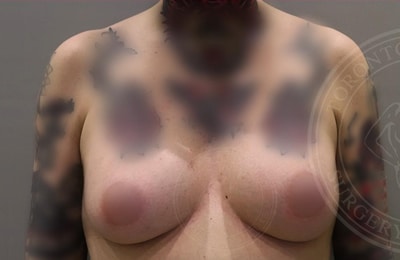 sixsurgery toronto male breast reduction before and after