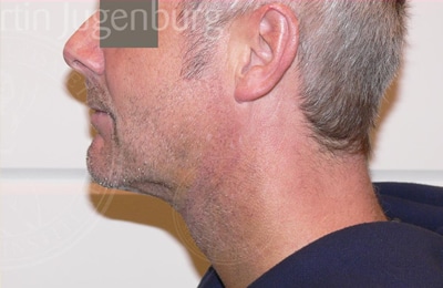 sixsurgery toronto neck liposuction before and after