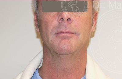 sixsurgery toronto neck liposuction before and after