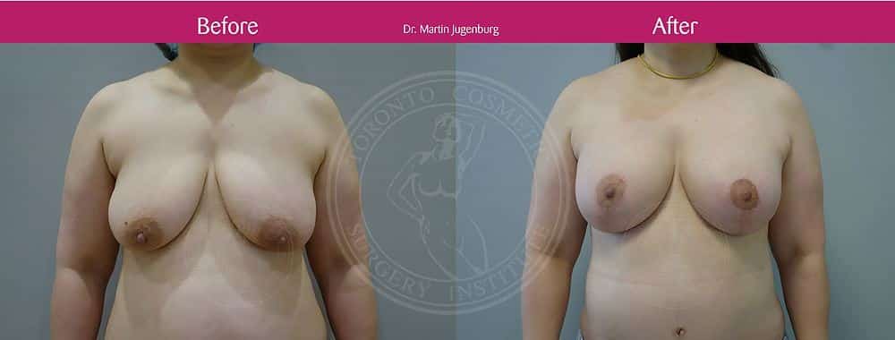 sixsurgery toronto breast lift mastopexy with implants before and after