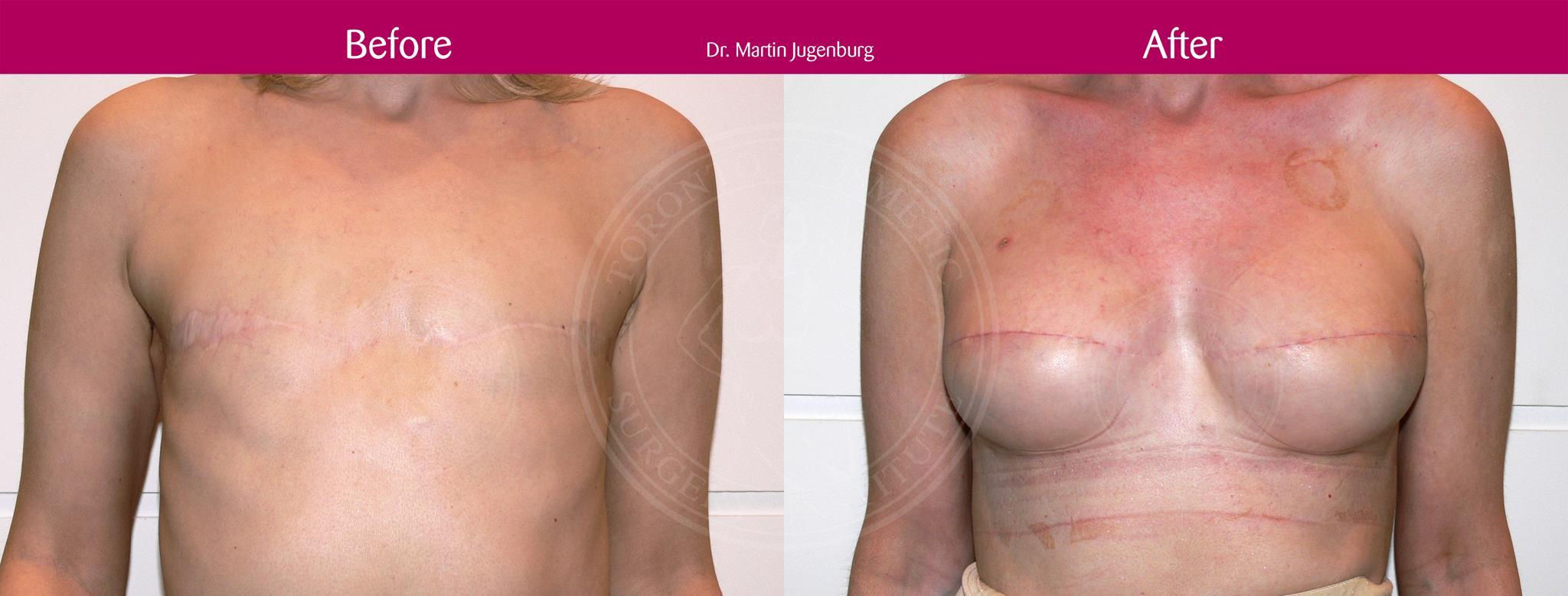 Breast Reconstruction Before After