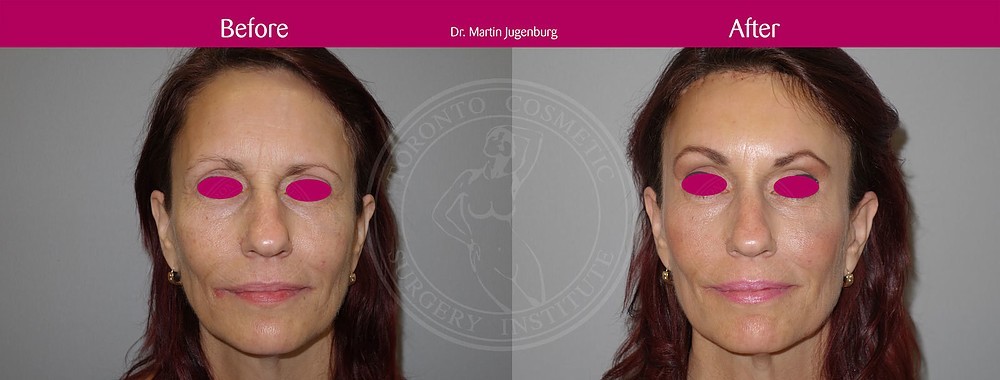 sixsurgery toronto browlift forehead lift before and after