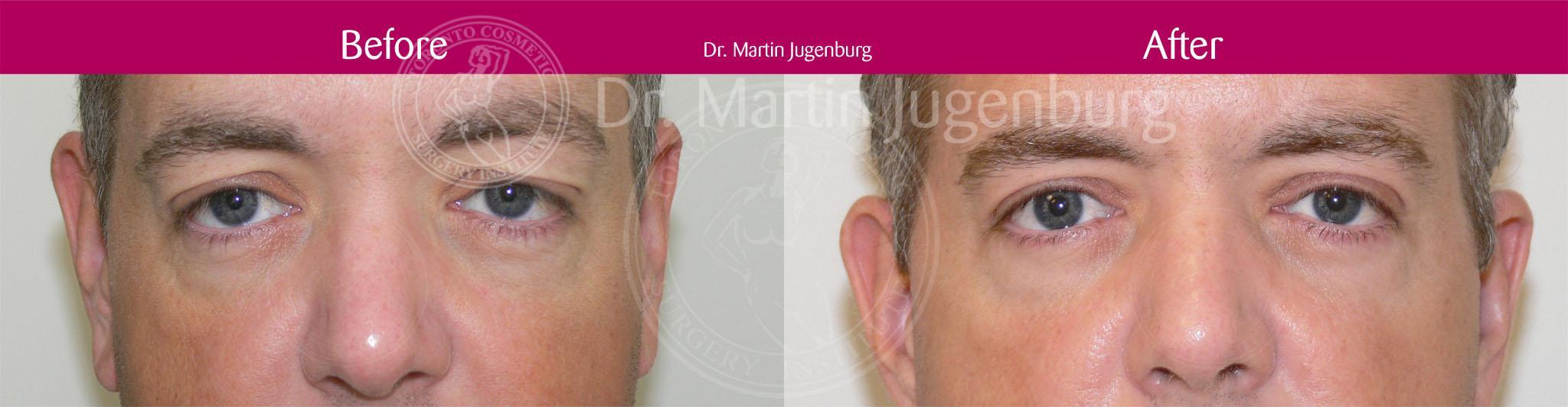 sixsurgery toronto blepharoplasty eyelid lift before and after