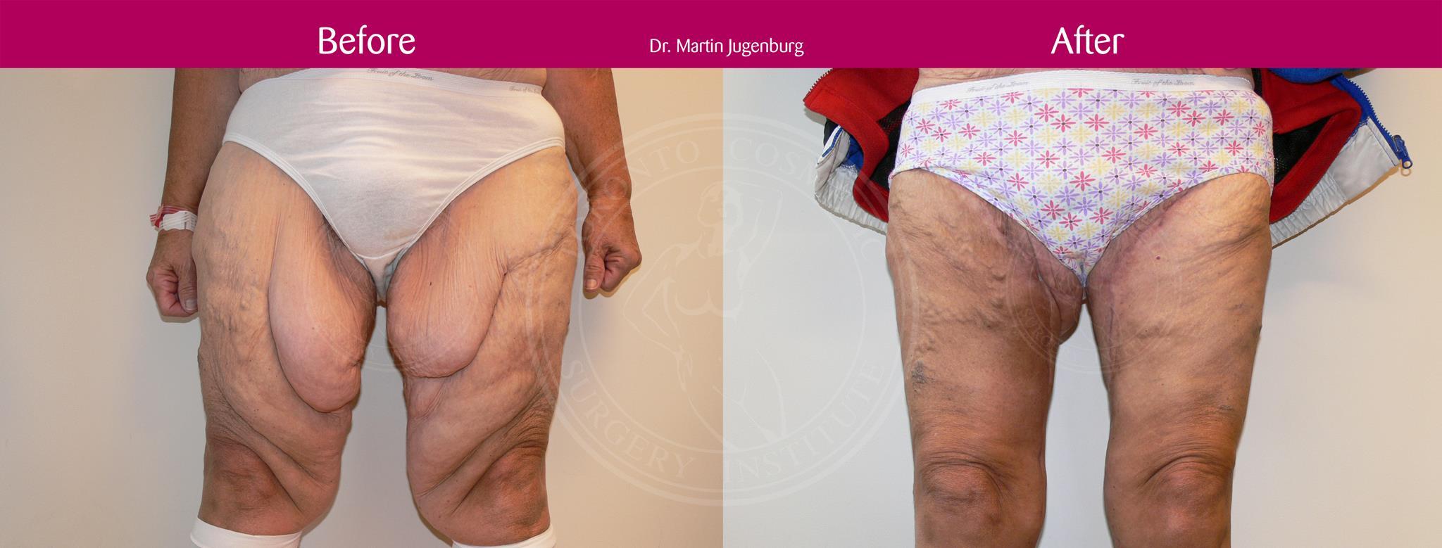 thigh lift before and after gallery