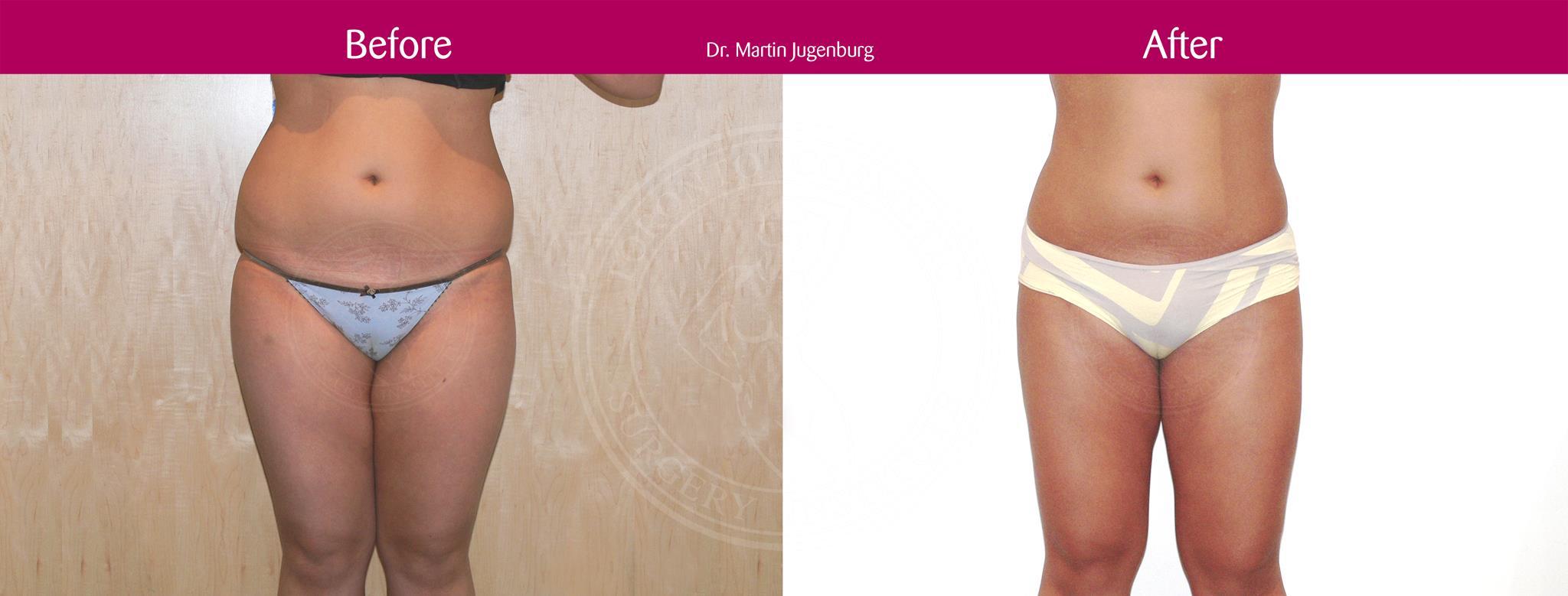 sixsurgery toronto liposuction before and after