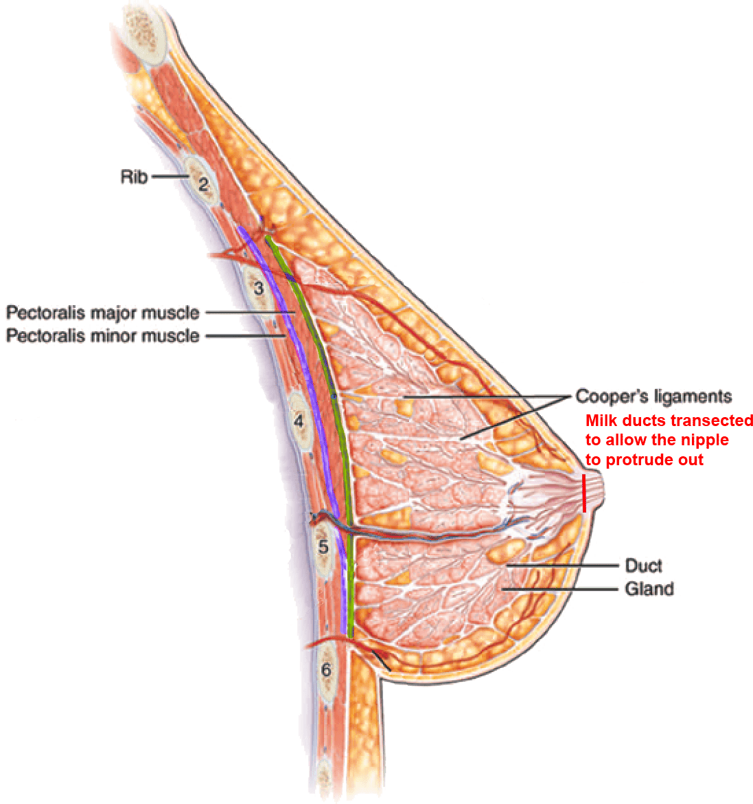 Inverted nipple correction