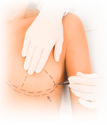 aloodless breast augmentation