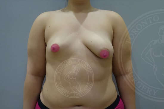 Breast Asymmetry Correction Before After