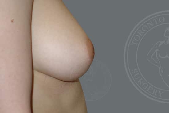 inverted nipples before