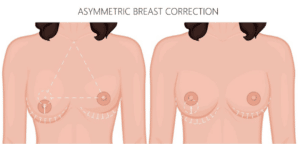 breast asymmetry correction